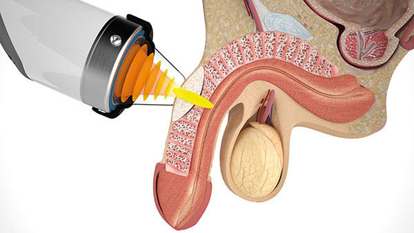 induratio penis plastica 2 - Boston Medical Group España