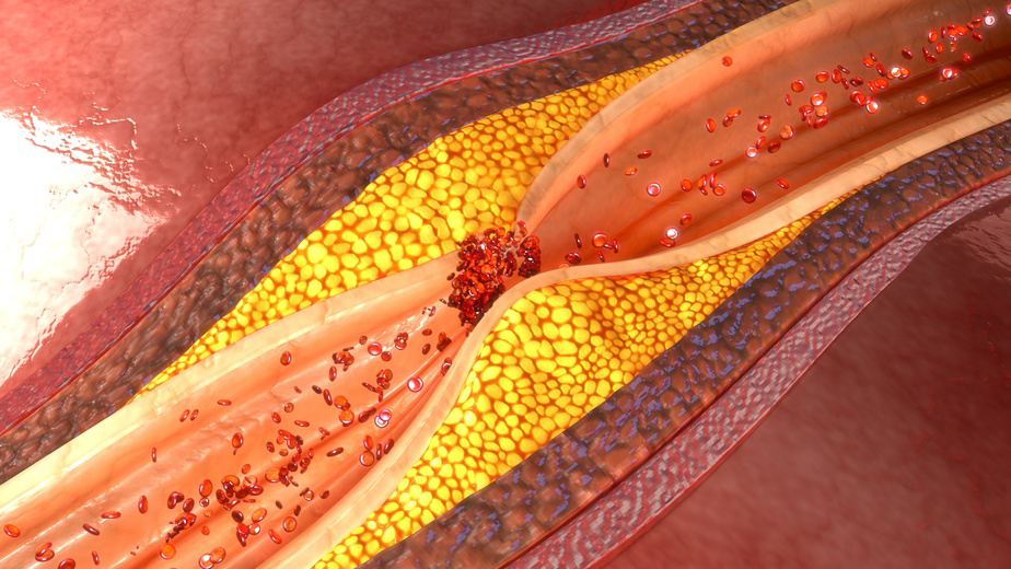 Coronary artery plaque