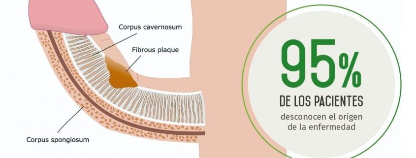 terapia de tubo para la impotencia terapia de tubo para la impotencia